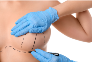 Técnica de implante mamário promove recuperação plena em 24h