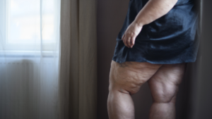 Lipedema